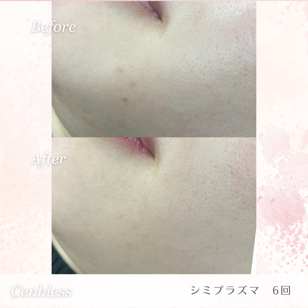 Cenbless　成増フェイシャル＆ネイルサロン　シミプラズマネオ-驚きの効果を発揮！Before＆After画像紹介