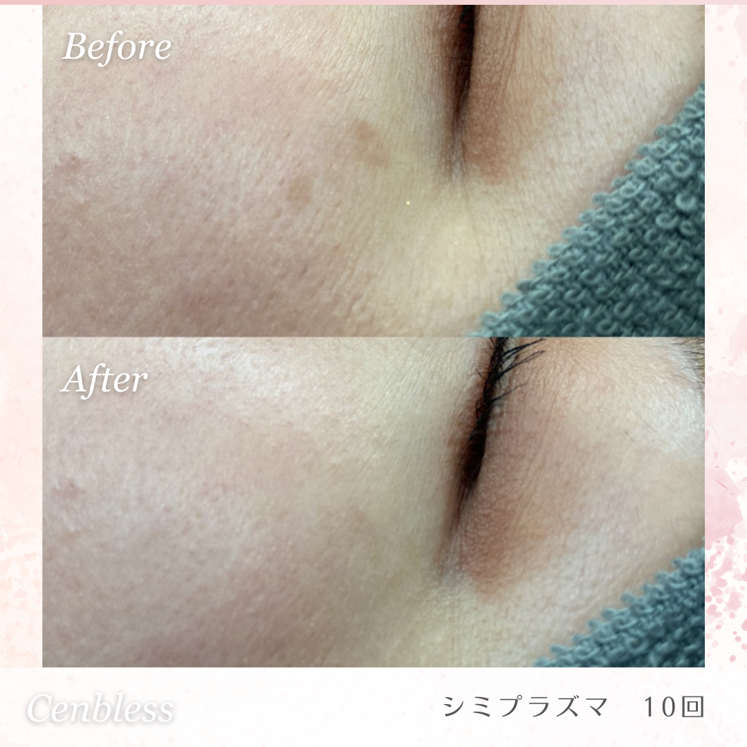 Cenbless　成増フェイシャル＆ネイルサロン　シミプラズマネオ-驚きの効果を発揮！Before＆After画像紹介