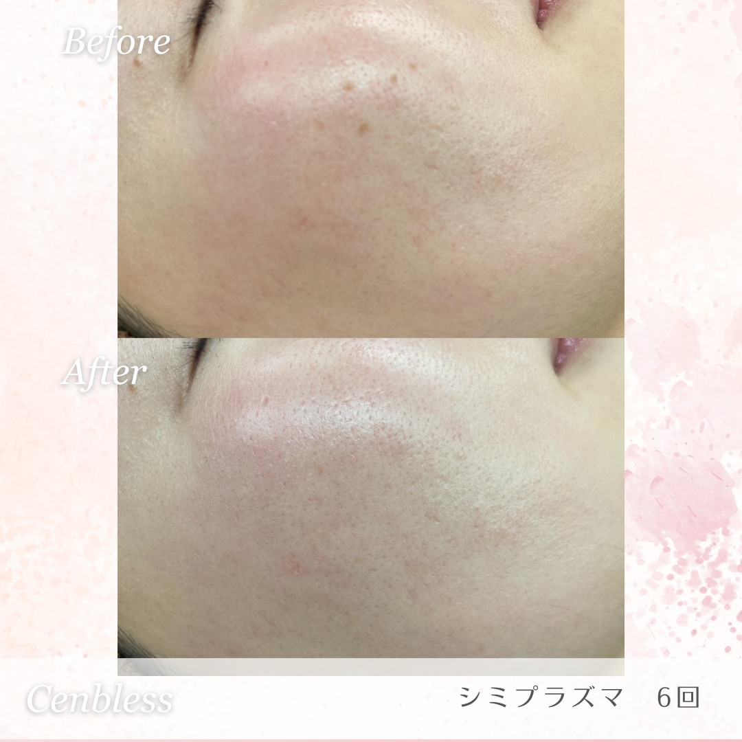 Cenbless　成増フェイシャル＆ネイルサロン　シミプラズマネオ-驚きの効果を発揮！Before＆After画像紹介