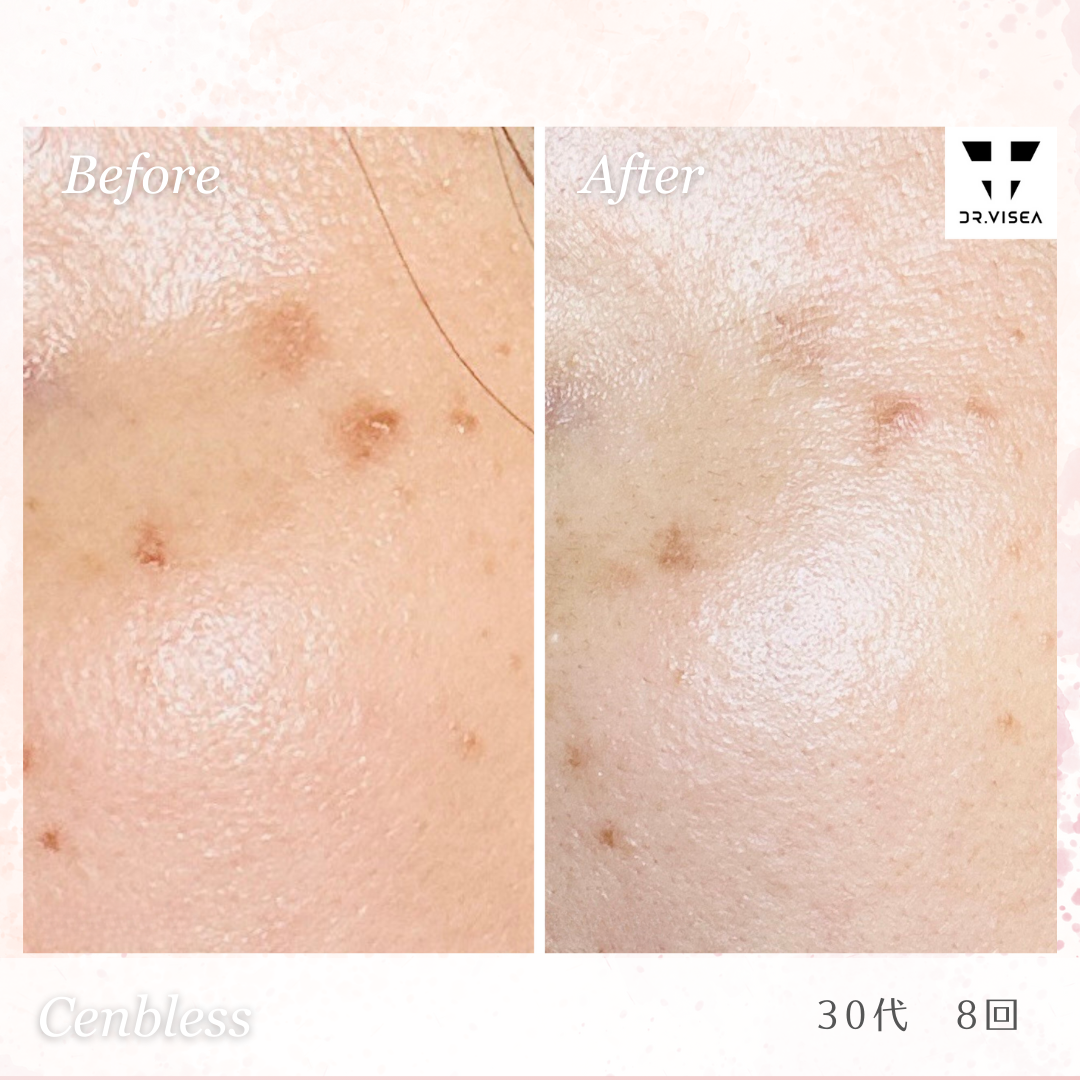 Cenbless　成増フェイシャル＆ネイルサロン　シミプラズマネオ-驚きの効果を発揮！Before＆After画像紹介