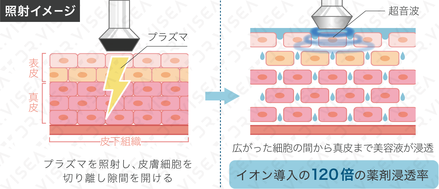 Cenbless　成増フェイシャル＆ネイルサロン　プラズマフェイシャル-超音波の仕組み